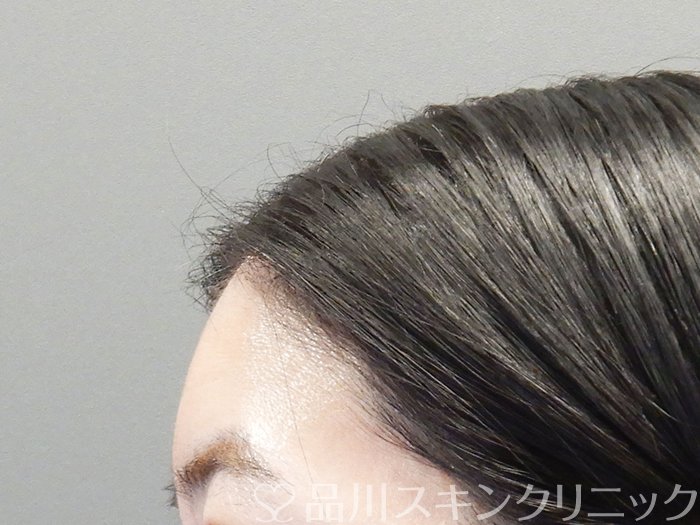 症例NO.72790のBEFORE写真