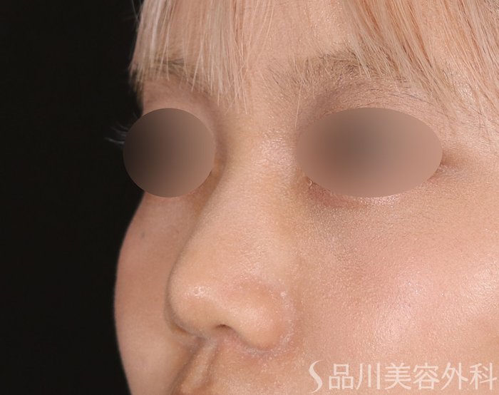 症例NO.71540のBEFORE写真