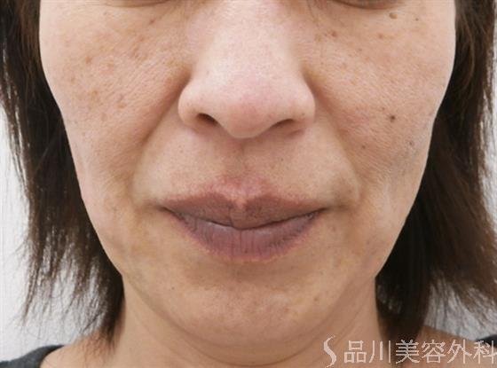 症例NO.25629のBEFORE写真