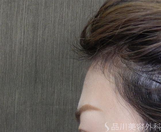 症例NO.59611のBEFORE写真