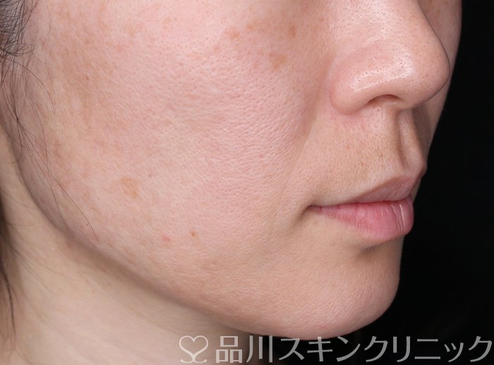 症例NO.69331のBEFORE写真