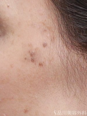 症例NO.72697のAFTER写真