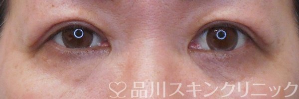 症例NO.71224のAFTER写真