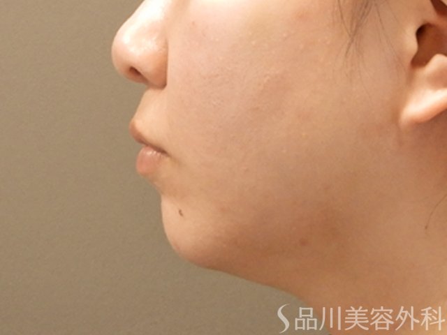 症例NO.71551のBEFORE写真