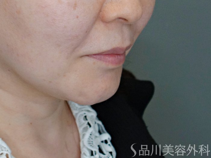 症例NO.69435のBEFORE写真