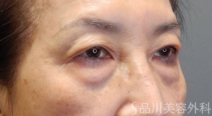 症例NO.71187のBEFORE写真