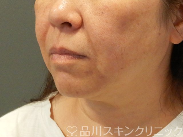 症例NO.66459のBEFORE写真