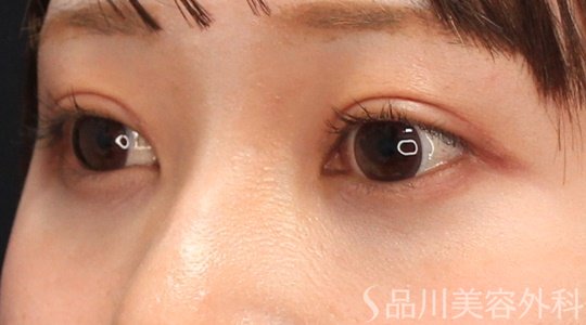 症例NO.70291のAFTER写真