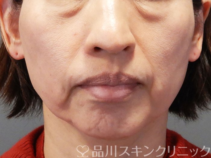 症例NO.72853のBEFORE写真