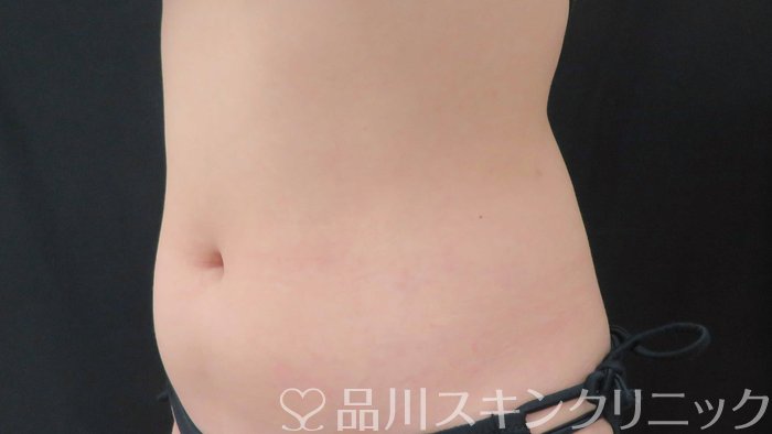 症例NO.70867のBEFORE写真