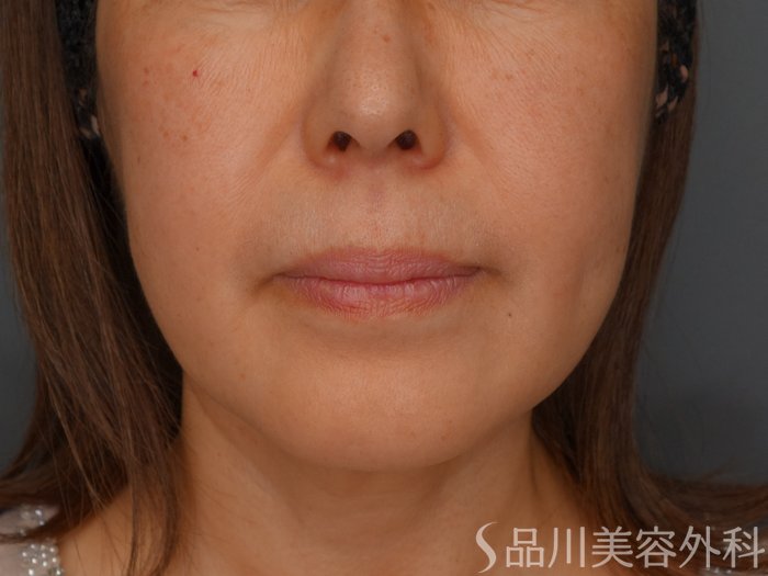 症例NO.73278のBEFORE写真