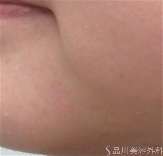 症例NO.18511のAFTER写真