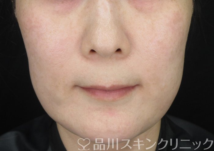 症例NO.62236のBEFORE写真