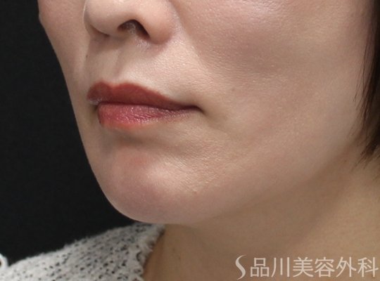 症例NO.75257のAFTER写真