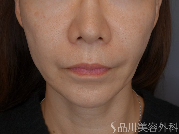 症例NO.72328のBEFORE写真