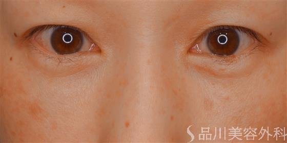 症例NO.59537のAFTER写真