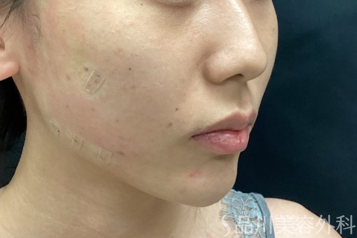 症例NO.67783のAFTER写真