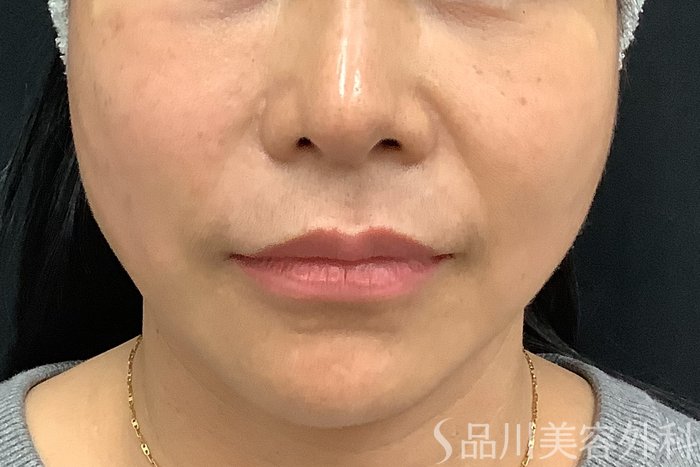 症例NO.73318のAFTER写真