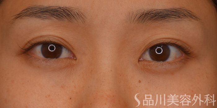 症例NO.73722のBEFORE写真