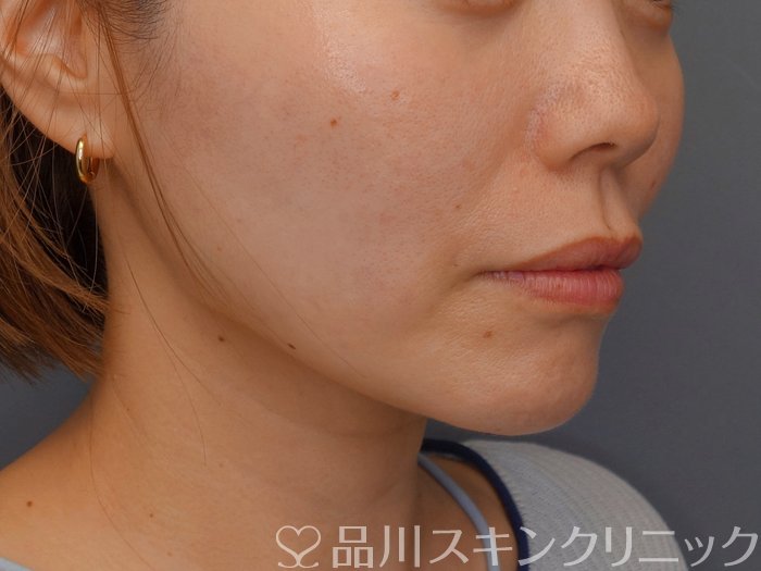 症例NO.74898のAFTER写真