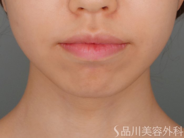 症例NO.70454のBEFORE写真
