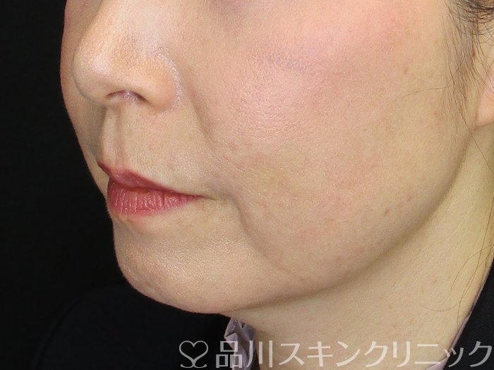 症例NO.73156のBEFORE写真