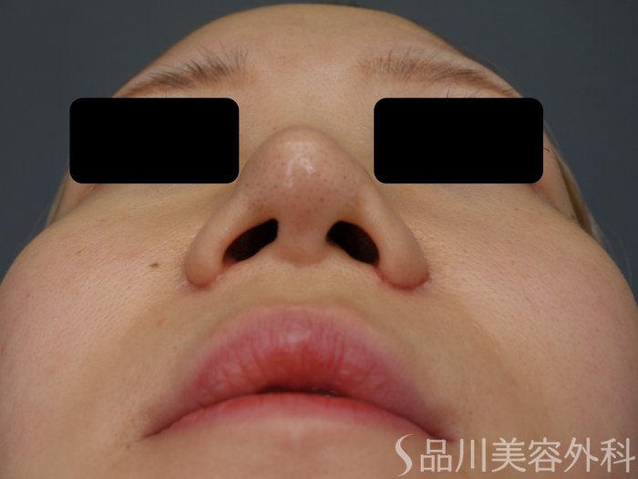 症例NO.73395のAFTER写真