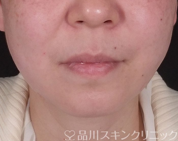症例NO.69543のAFTER写真
