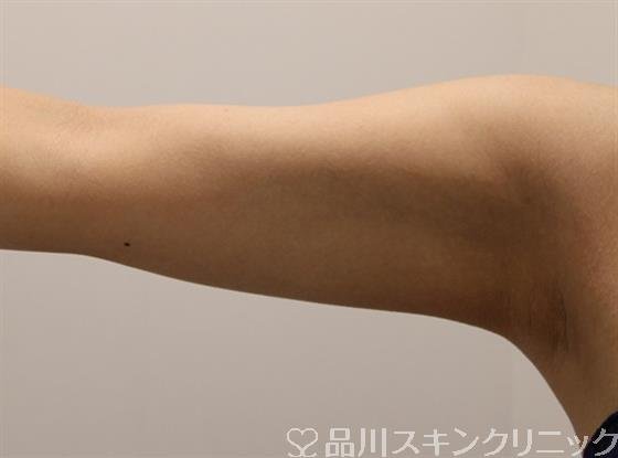 症例NO.48001のAFTER写真