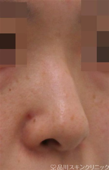 症例NO.38833のBEFORE写真