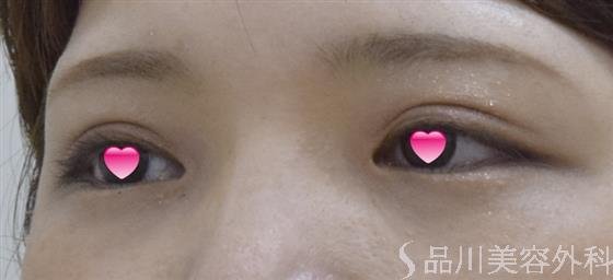 症例NO.53163のAFTER写真