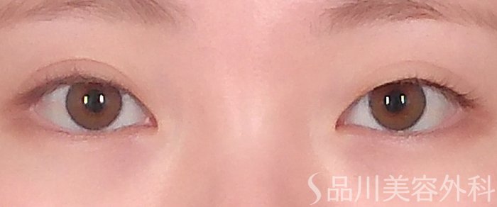 症例NO.70990のBEFORE写真