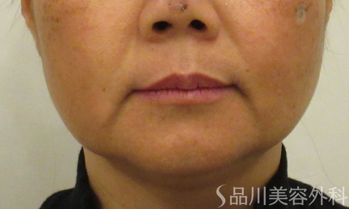 症例NO.73232のBEFORE写真