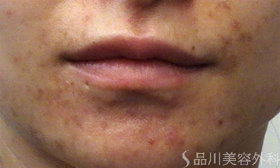 症例NO.47223のBEFORE写真