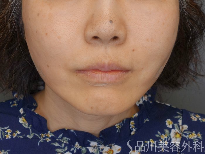 症例NO.70853のAFTER写真