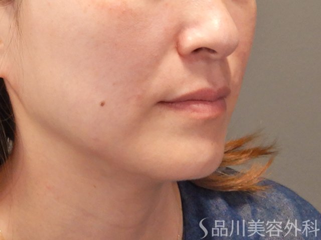 症例NO.74952のAFTER写真