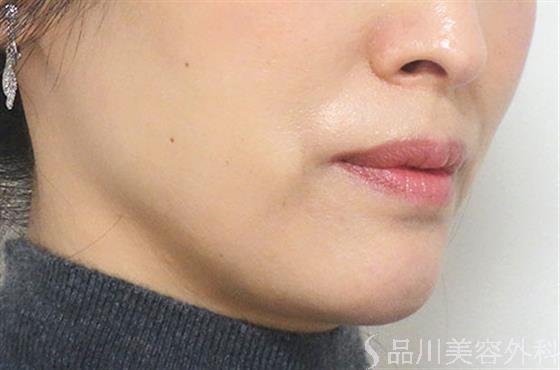 症例NO.21032のAFTER写真
