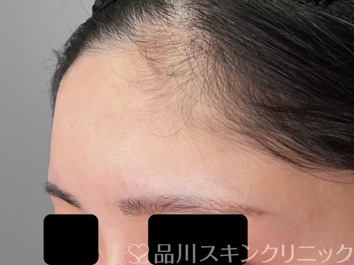 症例NO.70220のAFTER写真