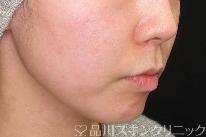 症例NO.73631のBEFORE写真