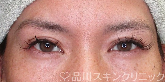 症例NO.74260のAFTER写真