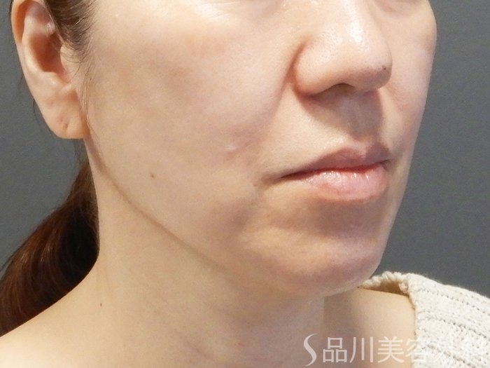 症例NO.75075のAFTER写真