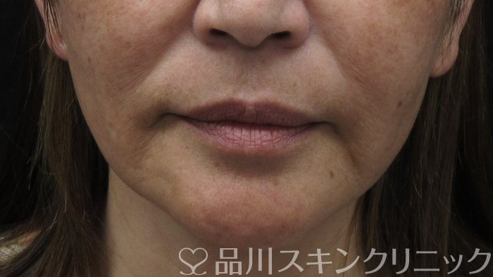 症例NO.71322のBEFORE写真