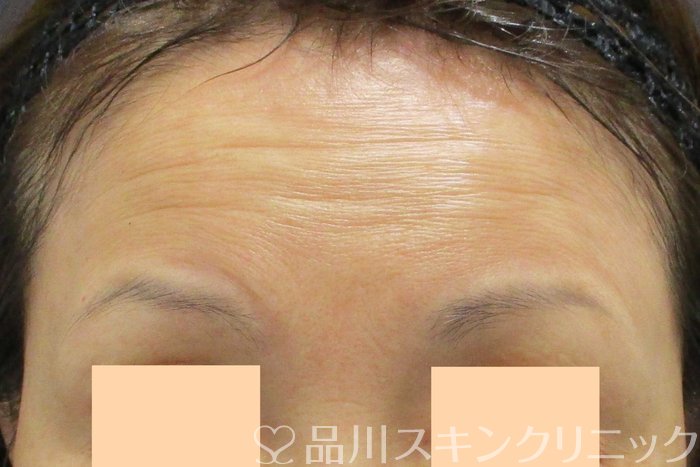 症例NO.67365のBEFORE写真