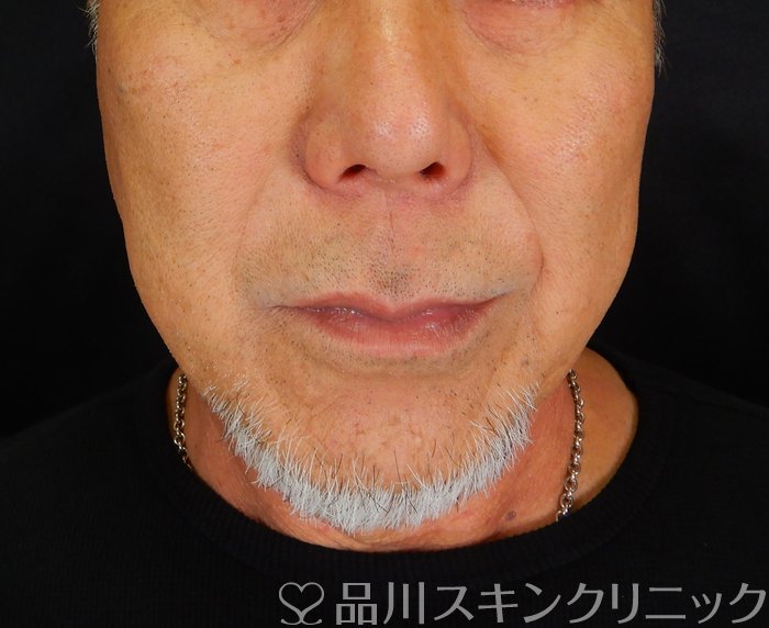 症例NO.66347のAFTER写真