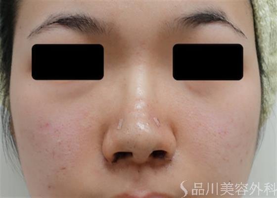 症例NO.25657のAFTER写真