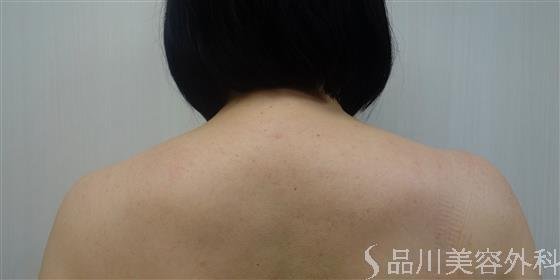 症例NO.51113のAFTER写真