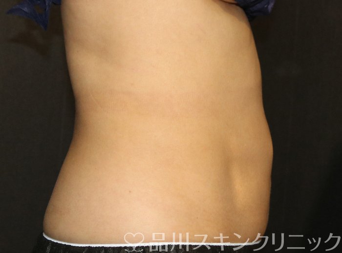 症例NO.70796のAFTER写真