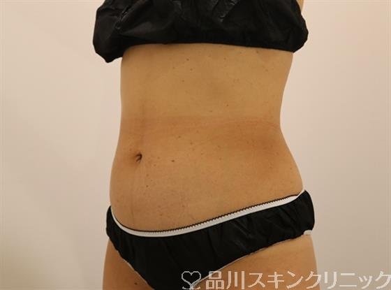 症例NO.44064のAFTER写真