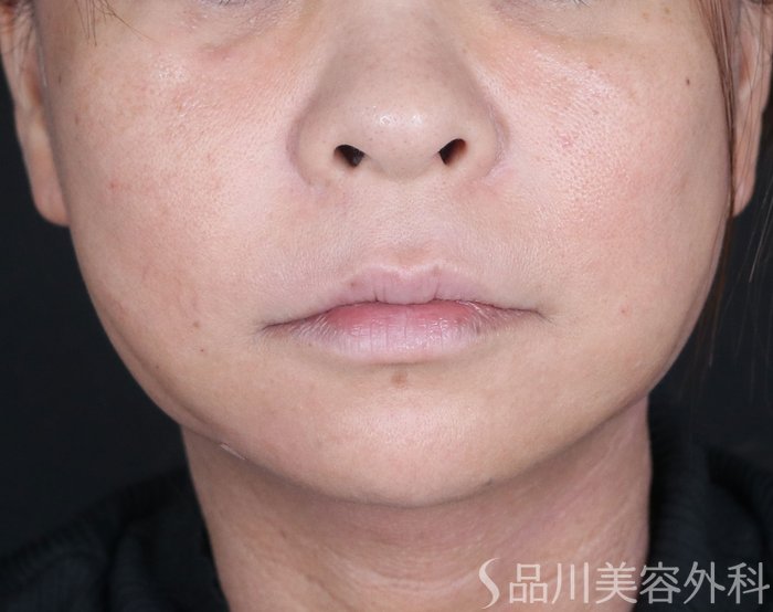 症例NO.73599のAFTER写真