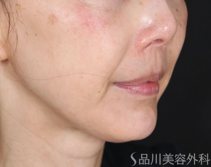 症例NO.74131のBEFORE写真
